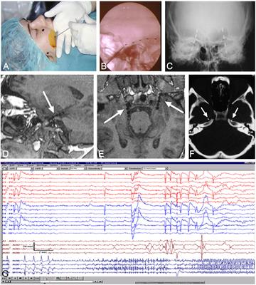 Neuroanatomical and psychological considerations in temporal lobe epilepsy